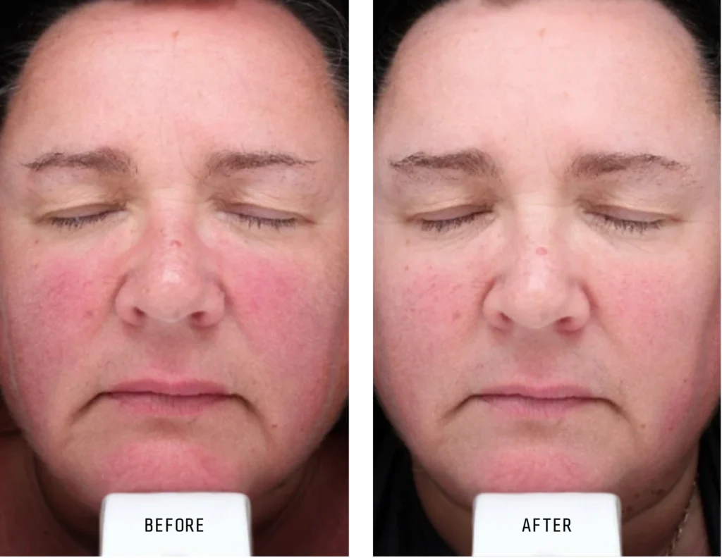 Before and after 1.webp